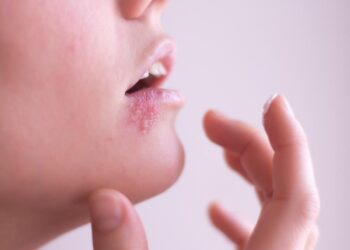 Como saber se você tem herpes?