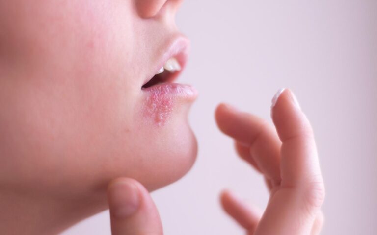 Como saber se você tem herpes?