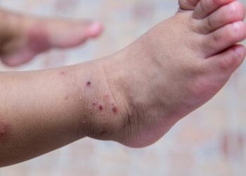 Ouro Preto (MG) vive surto da síndrome ‘mão-pé-boca’ e suspende aulas