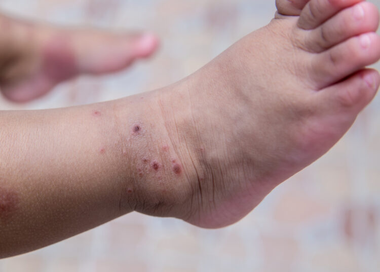 Ouro Preto (MG) vive surto da síndrome ‘mão-pé-boca’ e suspende aulas