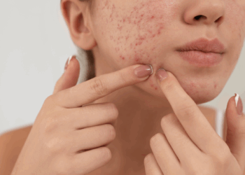 Sinergia para tratar acne através da aromaterapia, veja receita!