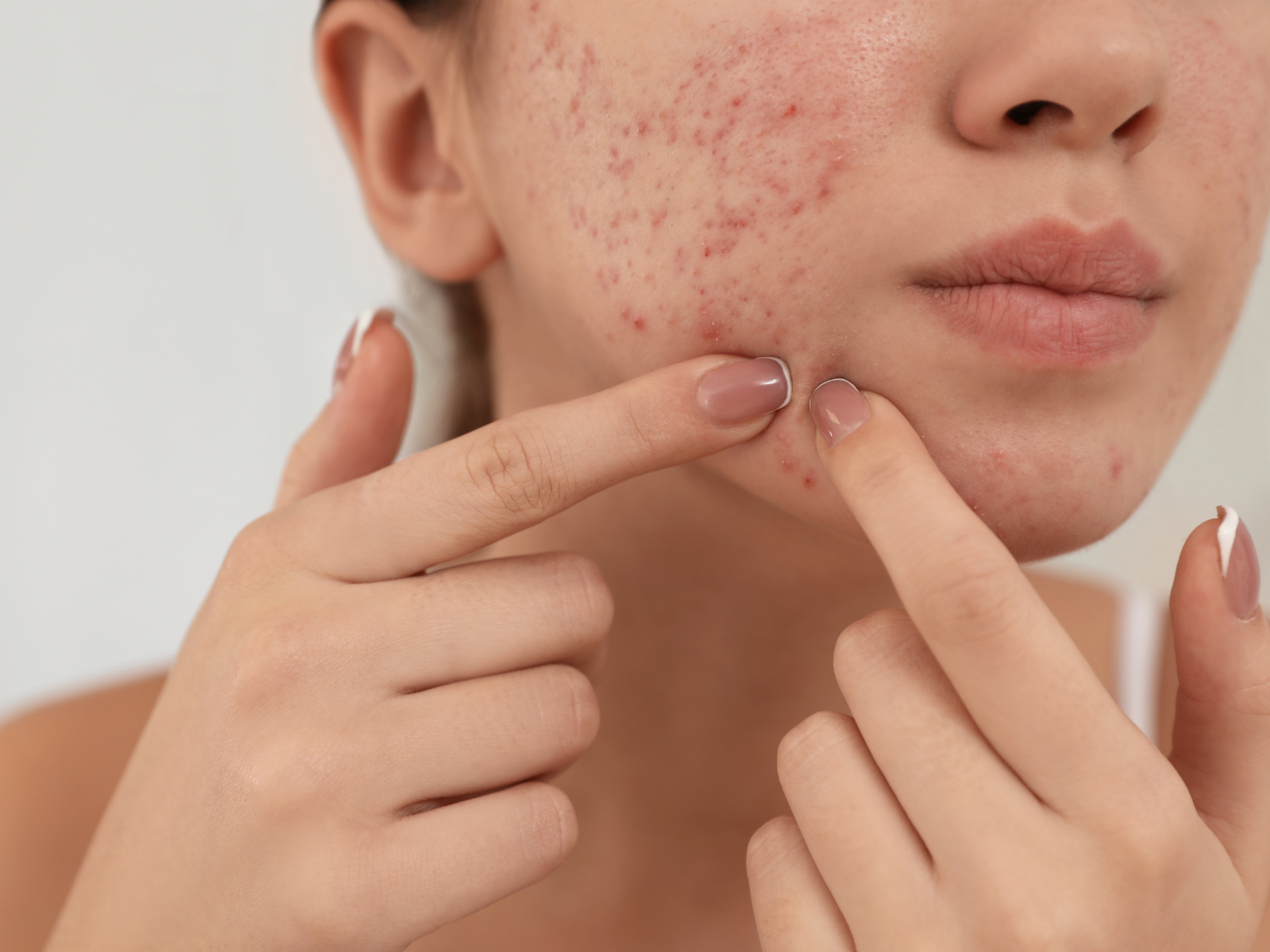 Sinergia para tratar acne através da aromaterapia, veja receita!