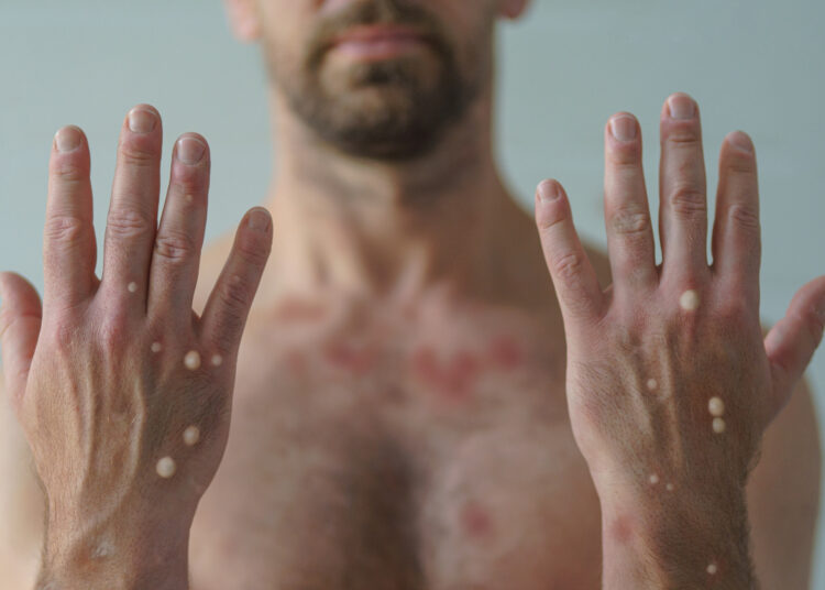 Mariana tem 1º caso de varíola dos macacos confirmado