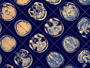 Droga para Alzheimer, lecanemab, é aclamada como avanço importante Droga para Alzheimer, lecanemab, é aclamada como avanço importante