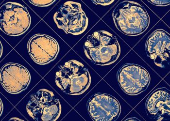 Droga para Alzheimer, lecanemab, é aclamada como avanço importante