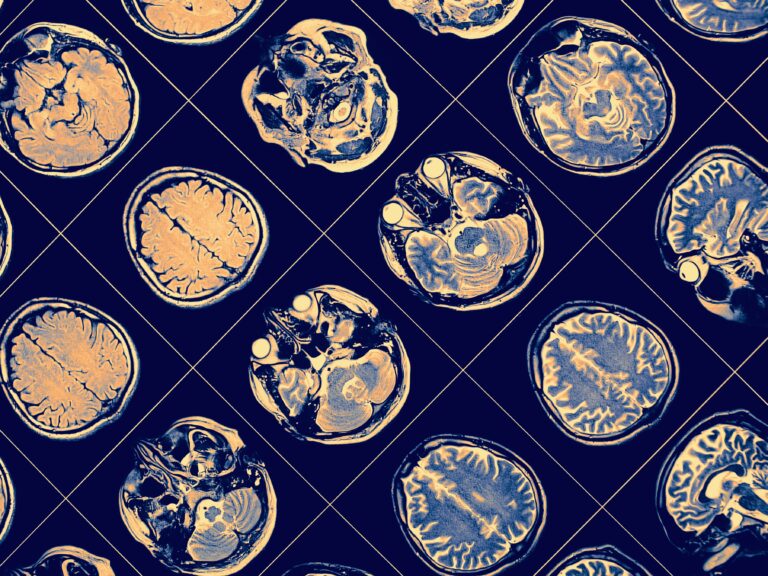 Droga para Alzheimer, lecanemab, é aclamada como avanço importante