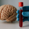 Brasil avança em exame de sangue que detecta Alzheimer com mais de 90% de precisão
