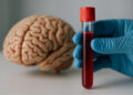 Brasil avança em exame de sangue que detecta Alzheimer com mais de 90% de precisão
